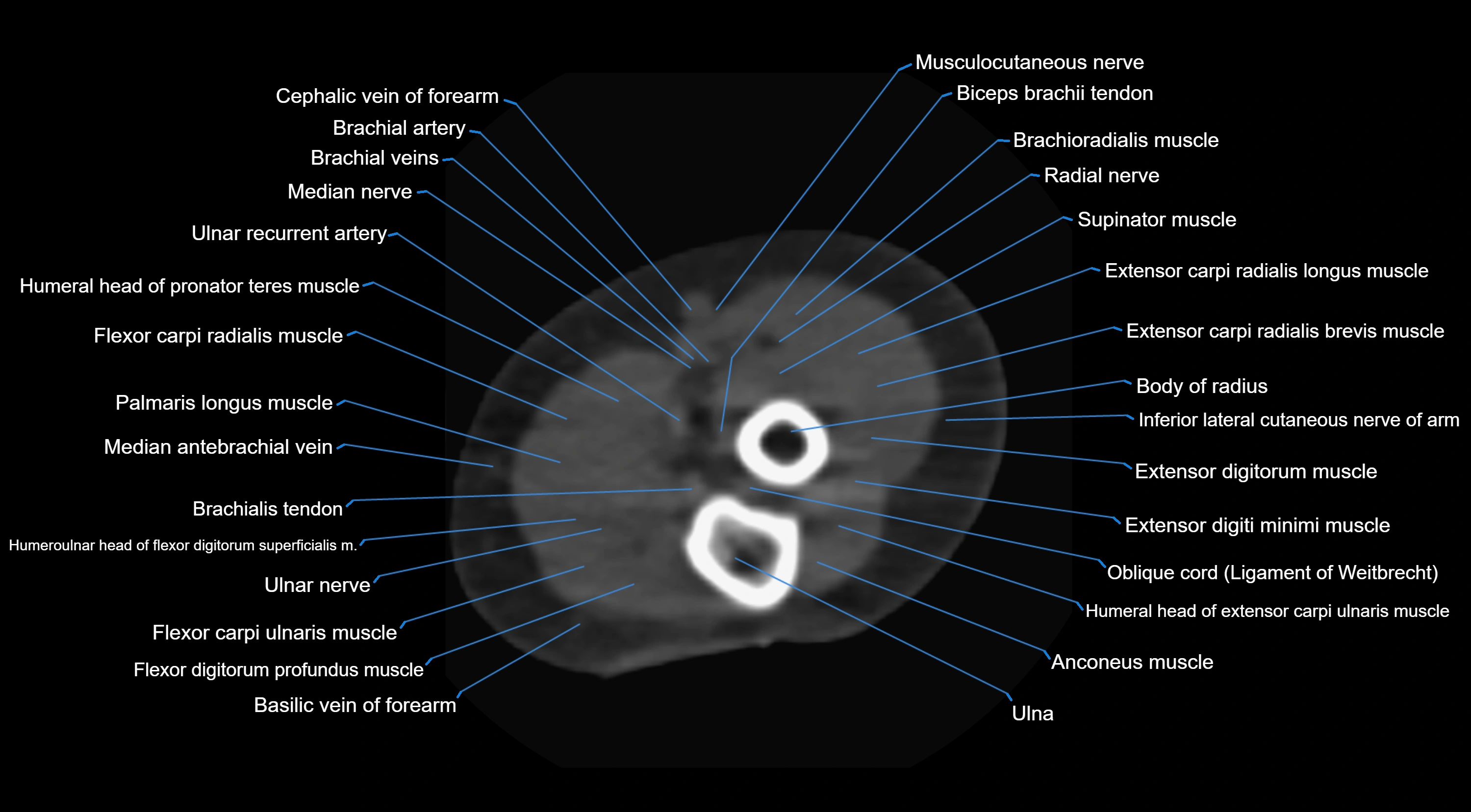 CT elbow axial  cross sectional anatomy labelled  radiology image -00039.webp